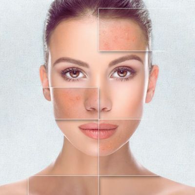 Tratamiento acne